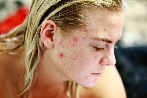 Bahaya Skincare Oplosan